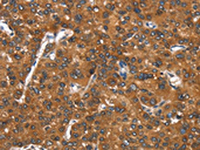 The image on the left is immunohistochemistry of paraffin-embedded Human liver cancer tissue using CSB-PA246478(CADM4 Antibody) at dilution 1/25, on the right is treated with synthetic peptide. (Original magnification: ×200)
