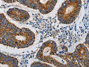 The image on the left is immunohistochemistry of paraffin-embedded Human colon cancer tissue using CSB-PA246788(MAP3K5 Antibody) at dilution 1/20, on the right is treated with synthetic peptide. (Original magnification: ×200)