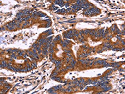 The image on the left is immunohistochemistry of paraffin-embedded Human colon cancer tissue using CSB-PA246816(KIR2DL3/KIR2DL1/KIR2DL4/KIR2DS4 Antibody) at dilution 1/30, on the right is treated with fusion protein. (Original magnification: ×200)