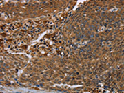 The image on the left is immunohistochemistry of paraffin-embedded Human cervical cancer tissue using CSB-PA247101(FLG Antibody) at dilution 1/20, on the right is treated with synthetic peptide. (Original magnification: ×200)