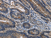 The image on the left is immunohistochemistry of paraffin-embedded Human colon cancer tissue using CSB-PA247118(ITPR2 Antibody) at dilution 1/40, on the right is treated with synthetic peptide. (Original magnification: ×200)