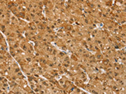 The image on the left is immunohistochemistry of paraffin-embedded Human liver cancer tissue using CSB-PA247131(TAF12 Antibody) at dilution 1/35, on the right is treated with fusion protein. (Original magnification: ×200)