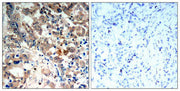 Immunohistochemical analysis of paraffin-embedded human lung carcinoma tissue, using AMPK-alpha;1/AMPK-alpha;2(Phospho-Thr174/Thr172) Antibody.