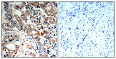 Immunohistochemical analysis of paraffin-embedded human lung carcinoma tissue, using AMPK-alpha;1/AMPK-alpha;2(Phospho-Thr174/Thr172) Antibody.