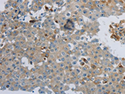 The image on the left is immunohistochemistry of paraffin-embedded Human breast cancer tissue using CSB-PA247166(CKMT1A/CKMT1B Antibody) at dilution 1/100, on the right is treated with synthetic peptide. (Original magnification: ×200)