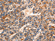 The image on the left is immunohistochemistry of paraffin-embedded Human liver cancer tissue using CSB-PA247335(GJA8 Antibody) at dilution 1/15, on the right is treated with synthetic peptide. (Original magnification: ×200)