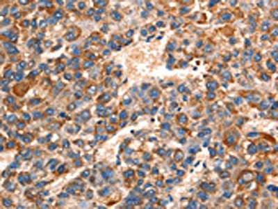 The image on the left is immunohistochemistry of paraffin-embedded Human liver cancer tissue using CSB-PA247335(GJA8 Antibody) at dilution 1/15, on the right is treated with synthetic peptide. (Original magnification: ×200)