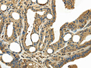 The image on the left is immunohistochemistry of paraffin-embedded Human thyroid cancer tissue using CSB-PA247380(KEAP1 Antibody) at dilution 1/20, on the right is treated with fusion protein. (Original magnification: ×200)