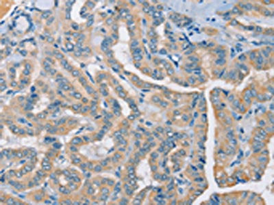 The image on the left is immunohistochemistry of paraffin-embedded Human thyroid cancer tissue using CSB-PA247431(RAD51 Antibody) at dilution 1/25, on the right is treated with synthetic peptide. (Original magnification: ×200)