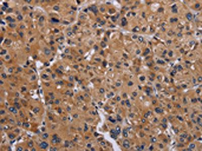 The image on the left is immunohistochemistry of paraffin-embedded Human liver cancer tissue using CSB-PA247539(GNAS Antibody) at dilution 1/30, on the right is treated with fusion protein. (Original magnification: ×200)