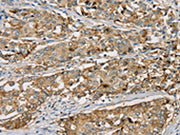 The image on the left is immunohistochemistry of paraffin-embedded Human liver cancer tissue using CSB-PA247632(SEMA6A Antibody) at dilution 1/20, on the right is treated with synthetic peptide. (Original magnification: ×200)
