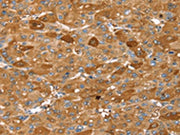 The image on the left is immunohistochemistry of paraffin-embedded Human liver cancer tissue using CSB-PA247700(FTH1 Antibody) at dilution 1/25, on the right is treated with fusion protein. (Original magnification: ×200)