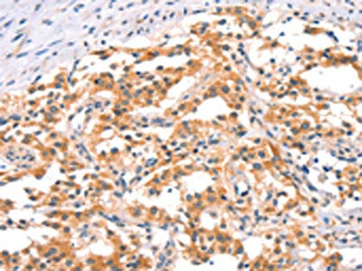 The image on the left is immunohistochemistry of paraffin-embedded Human thyroid cancer tissue using CSB-PA247753(IKBKB Antibody) at dilution 1/25, on the right is treated with synthetic peptide. (Original magnification: ×200)