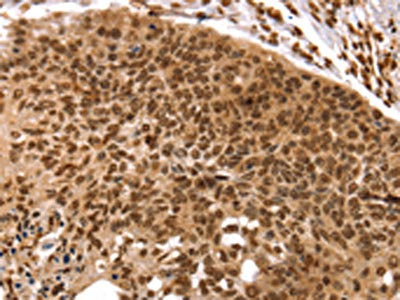 The image on the left is immunohistochemistry of paraffin-embedded Human esophagus cancer tissue using CSB-PA247863(TAF10 Antibody) at dilution 1/35, on the right is treated with synthetic peptide. (Original magnification: ×200)