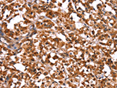 The image on the left is immunohistochemistry of paraffin-embedded Human thyroid cancer tissue using CSB-PA247916(GUK1 Antibody) at dilution 1/50, on the right is treated with synthetic peptide. (Original magnification: ×200)