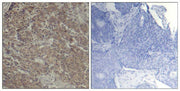 Immunohistochemical analysis of paraffin-embedded human breast carcinoma tissue using CREB(Ab-142) Antibody(left) or the same antibody preincubated with blocking peptide(right).