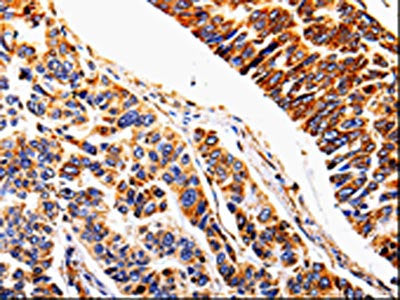 The image on the left is immunohistochemistry of paraffin-embedded Human lung cancer tissue using CSB-PA247988(IL1R2 Antibody) at dilution 1/20, on the right is treated with fusion protein. (Original magnification: ×200)