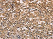 The image on the left is immunohistochemistry of paraffin-embedded Human thyroid cancer tissue using CSB-PA247989(DSTN Antibody) at dilution 1/30, on the right is treated with fusion protein. (Original magnification: ×200)