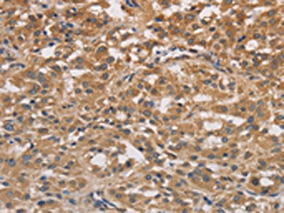 The image on the left is immunohistochemistry of paraffin-embedded Human thyroid cancer tissue using CSB-PA247989(DSTN Antibody) at dilution 1/30, on the right is treated with fusion protein. (Original magnification: ×200)