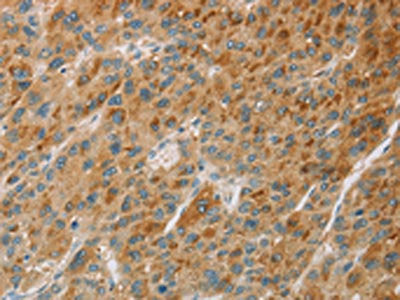 The image on the left is immunohistochemistry of paraffin-embedded Human liver cancer tissue using CSB-PA248001(CYP11B1 Antibody) at dilution 1/30, on the right is treated with fusion protein. (Original magnification: ×200)