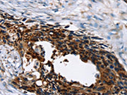 The image on the left is immunohistochemistry of paraffin-embedded Human esophagus cancer tissue using CSB-PA248283(AP1G1 Antibody) at dilution 1/45, on the right is treated with synthetic peptide. (Original magnification: ×200)