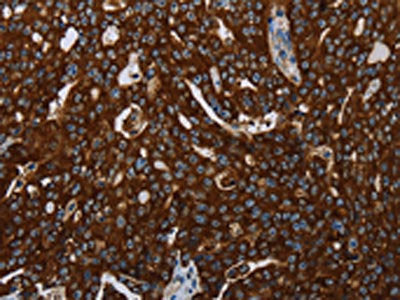 The image on the left is immunohistochemistry of paraffin-embedded Human ovarian cancer tissue using CSB-PA248650(KISS1R Antibody) at dilution 1/30, on the right is treated with synthetic peptide. (Original magnification: ×200)