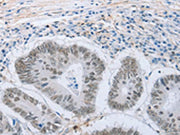 The image on the left is immunohistochemistry of paraffin-embedded Human colon cancer tissue using CSB-PA248806(NEUROG2 Antibody) at dilution 1/15, on the right is treated with synthetic peptide. (Original magnification: ×200)