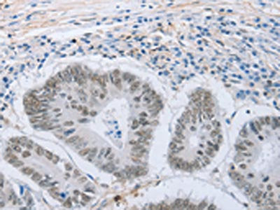 The image on the left is immunohistochemistry of paraffin-embedded Human colon cancer tissue using CSB-PA248806(NEUROG2 Antibody) at dilution 1/15, on the right is treated with synthetic peptide. (Original magnification: ×200)