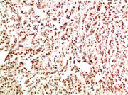 Immunohistochemical analysis of paraffin-embedded Human Breast Carcinoma Tissue using Gab1 Rabbit pAb diluted at 1:500