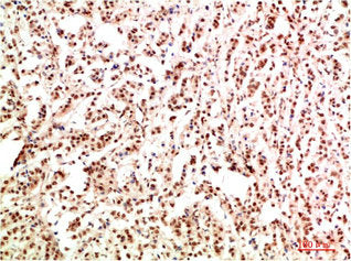 Immunohistochemical analysis of paraffin-embedded Human Breast Carcinoma Tissue using Gab1 Rabbit pAb diluted at 1:500