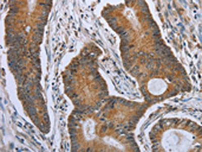 The image on the left is immunohistochemistry of paraffin-embedded Human colon cancer tissue using CSB-PA249091(TNFRSF13C Antibody) at dilution 1/40, on the right is treated with synthetic peptide. (Original magnification: ×200)