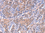The image on the left is immunohistochemistry of paraffin-embedded Human gastic cancer tissue using CSB-PA249150(EP300 Antibody) at dilution 1/20, on the right is treated with synthetic peptide. (Original magnification: ×200)