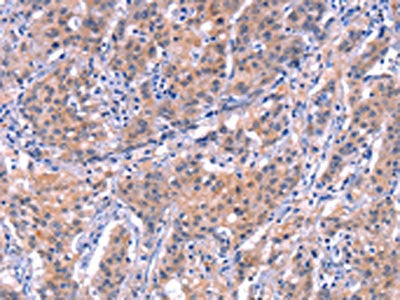 The image on the left is immunohistochemistry of paraffin-embedded Human gastic cancer tissue using CSB-PA249150(EP300 Antibody) at dilution 1/20, on the right is treated with synthetic peptide. (Original magnification: ×200)