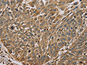 The image on the left is immunohistochemistry of paraffin-embedded Human lung cancer tissue using CSB-PA249474(MYL3 Antibody) at dilution 1/45, on the right is treated with fusion protein. (Original magnification: ×200)