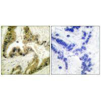 Immunohistochemical analysis of paraffin-embedded human lung carcinoma tissue using HDAC10 antibody.