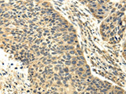 The image on the left is immunohistochemistry of paraffin-embedded Human esophagus cancer tissue using CSB-PA249540(RASD2 Antibody) at dilution 1/25, on the right is treated with fusion protein. (Original magnification: ×200)