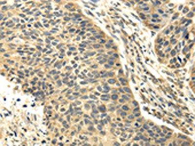 The image on the left is immunohistochemistry of paraffin-embedded Human esophagus cancer tissue using CSB-PA249540(RASD2 Antibody) at dilution 1/25, on the right is treated with fusion protein. (Original magnification: ×200)