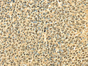 The image on the left is immunohistochemistry of paraffin-embedded Human ovarian cancer tissue using CSB-PA249582(RPA2 Antibody) at dilution 1/40, on the right is treated with fusion protein. (Original magnification: ×200)