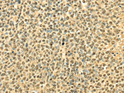 The image on the left is immunohistochemistry of paraffin-embedded Human ovarian cancer tissue using CSB-PA249582(RPA2 Antibody) at dilution 1/40, on the right is treated with fusion protein. (Original magnification: ×200)