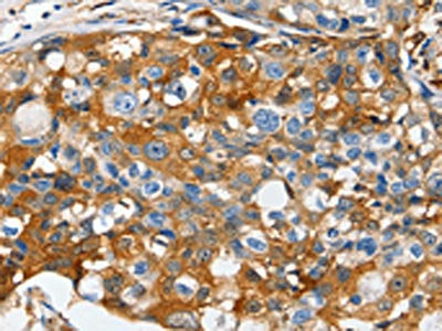The image on the left is immunohistochemistry of paraffin-embedded Human breast cancer tissue using CSB-PA249658(LRP1 Antibody) at dilution 1/50, on the right is treated with synthetic peptide. (Original magnification: ×200)