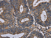The image on the left is immunohistochemistry of paraffin-embedded Human colon cancer tissue using CSB-PA250008(PVRL3 Antibody) at dilution 1/40, on the right is treated with fusion protein. (Original magnification: ×200)