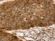 The image on the left is immunohistochemistry of paraffin-embedded Human esophagus cancer tissue using CSB-PA250093(TPST2 Antibody) at dilution 1/35, on the right is treated with synthetic peptide. (Original magnification: ×200)