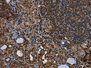 The image on the left is immunohistochemistry of paraffin-embedded Human thyroid cancer tissue using CSB-PA250156(HMGCL Antibody) at dilution 1/20, on the right is treated with fusion protein. (Original magnification: ×200)