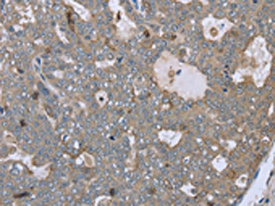 The image on the left is immunohistochemistry of paraffin-embedded Human ovarian cancer tissue using CSB-PA250242(FAR2 Antibody) at dilution 1/40, on the right is treated with fusion protein. (Original magnification: ×200)