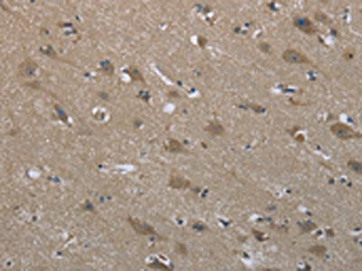 The image on the left is immunohistochemistry of paraffin-embedded Human brain tissue using CSB-PA250474(SYT3 Antibody) at dilution 1/50, on the right is treated with fusion protein. (Original magnification: ×200)