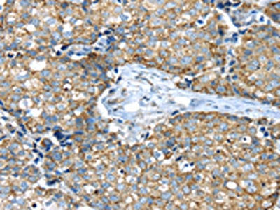 The image on the left is immunohistochemistry of paraffin-embedded Human gastic cancer tissue using CSB-PA250552(IFNA2 Antibody) at dilution 1/40, on the right is treated with synthetic peptide. (Original magnification: ×200)