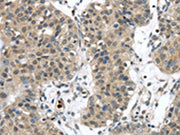 The image on the left is immunohistochemistry of paraffin-embedded Human breast cancer tissue using CSB-PA250761(SENP6 Antibody) at dilution 1/20, on the right is treated with synthetic peptide. (Original magnification: ×200)