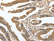 The image on the left is immunohistochemistry of paraffin-embedded Human colon cancer tissue using CSB-PA250828(CKAP2 Antibody) at dilution 1/70, on the right is treated with fusion protein. (Original magnification: ×200)