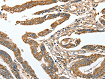 The image on the left is immunohistochemistry of paraffin-embedded Human colon cancer tissue using CSB-PA250828(CKAP2 Antibody) at dilution 1/70, on the right is treated with fusion protein. (Original magnification: ×200)
