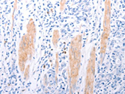 The image on the left is immunohistochemistry of paraffin-embedded Human gastic cancer tissue using CSB-PA250941(LPAR2 Antibody) at dilution 1/40, on the right is treated with synthetic peptide. (Original magnification: ×200)